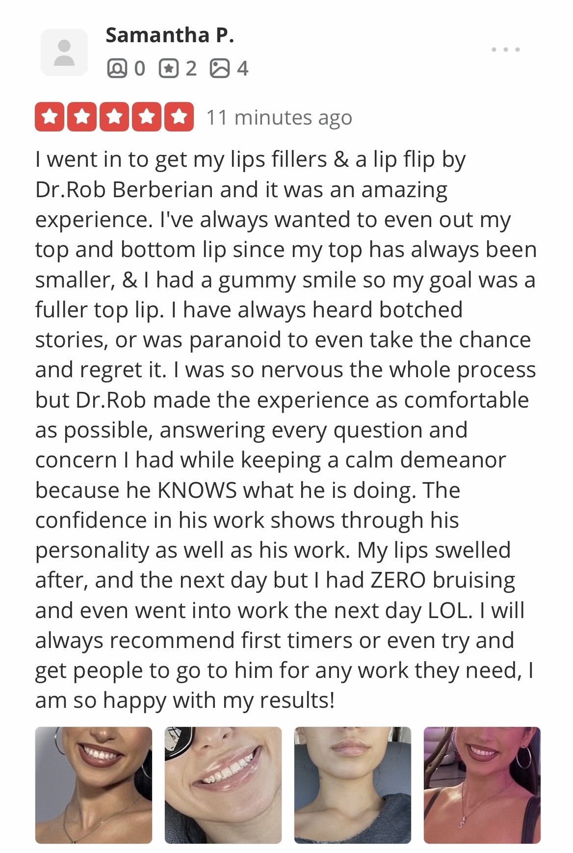 Dr. Rob Berberian Lip Filler Lip Flip Newport Beach Los Angeles California