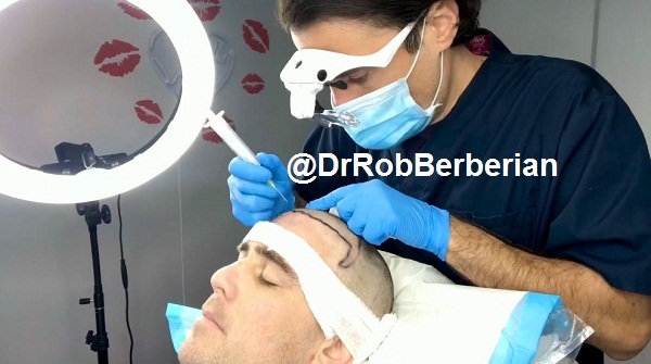 Exosome PRP Hair Transplant in LA & Newport Beach Dr. Rob Berberian