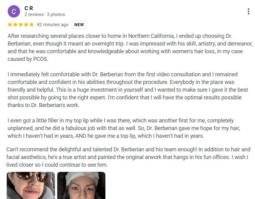 Dr. Rob Berberian FUE Hair Transplant Reviews Newport Beach California USA