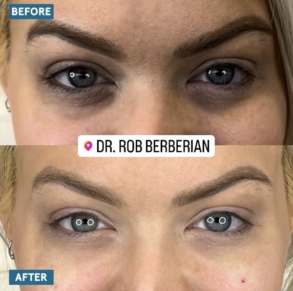 Celebrity Under Eye Filler Orange County Newport Beach Dr. Rob Berberian