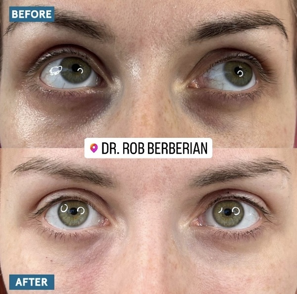 Celebrity Under Eye Filler Orange County Newport Beach Dr. Rob Berberian