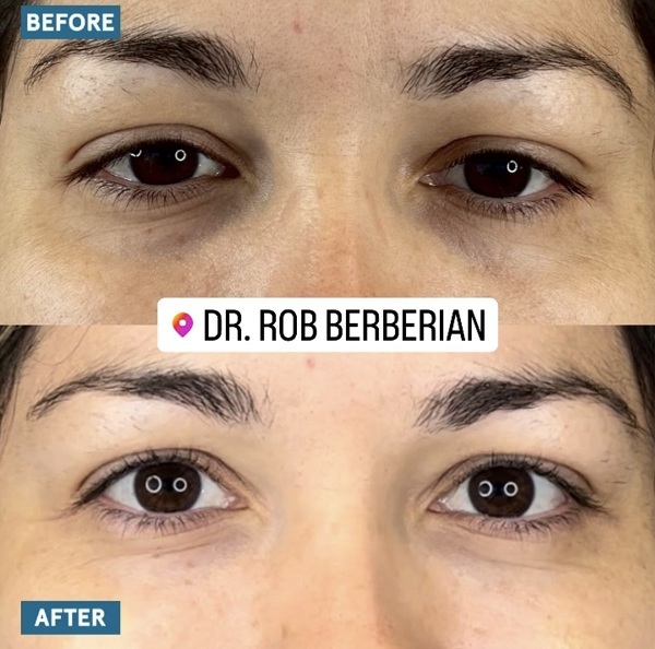 Celebrity Under Eye Filler Orange County Newport Beach Dr. Rob Berberian