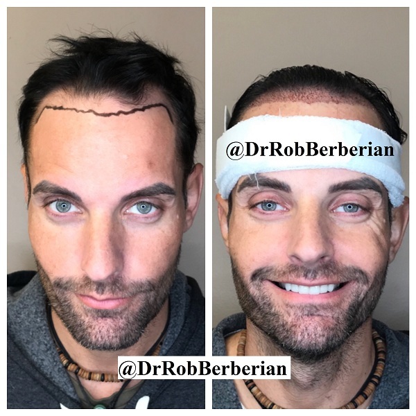 Christian Cage Hair Transplant Dr. Rob Berberian Newport Beach, California