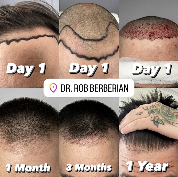 Dr. Rob Berberian FUE Hair Transplant Los Angeles Newport Beach 1000-4000 Grafts
