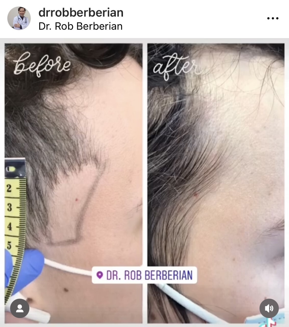 PRP Hair Injections Newport Beach & Orange County