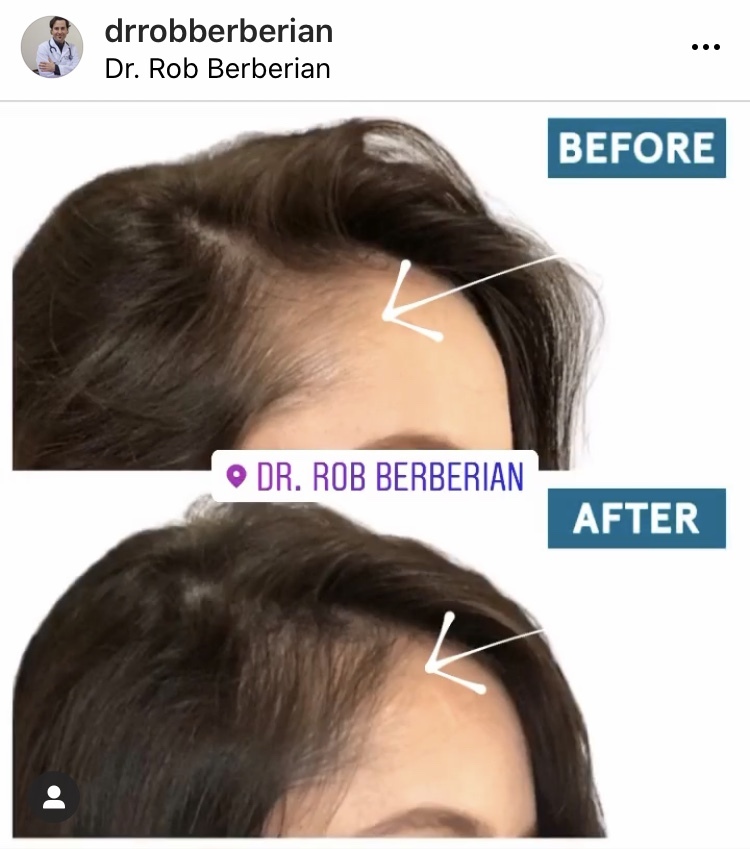 PRP Hair Injections Orange County & Newport Beach, CA