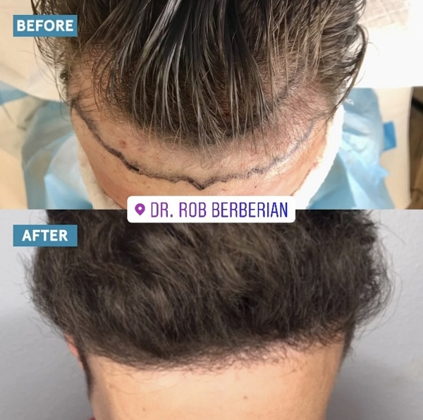 Before After Photos FUE Hair Transplant Newport Beach Orange County Dr. Rob Berberian
