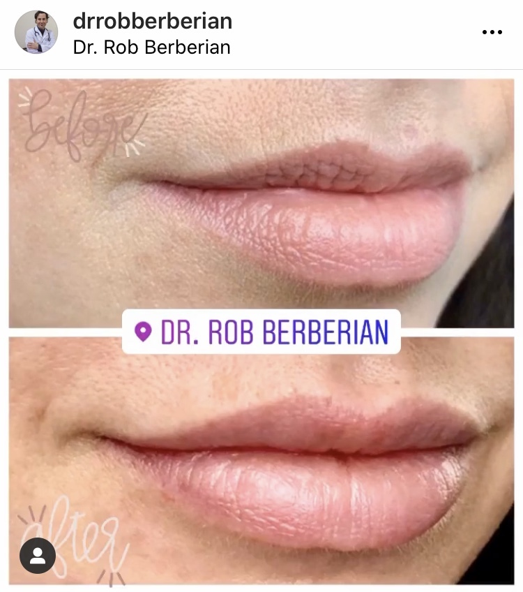 Lip Filler Orange County Newport Beach Before After Dr. Rob Berberian