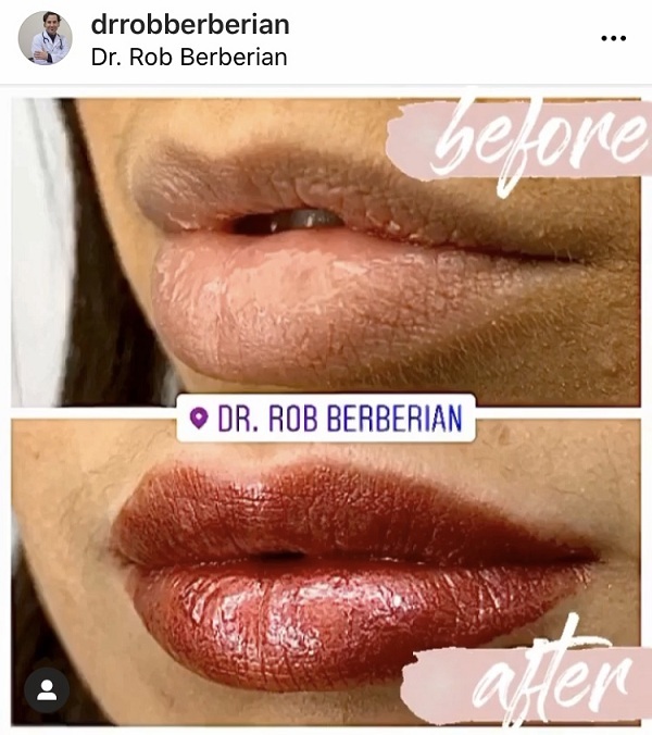 Best Lip Filler Newport Beach Orange County Dr. Rob Berberian