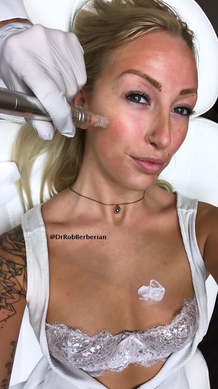 PRP Facial with Microneedling Dr. Rob Berberian Newport Beach Orange County