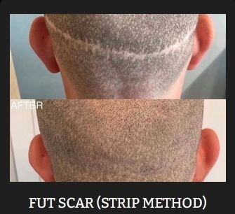 Scalp Micropigementation in Los Angeles & Orange County Newport Beach California