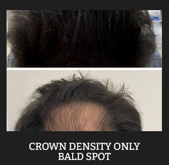 Scalp Micropigementation in Los Angeles & Orange County Newport Beach California