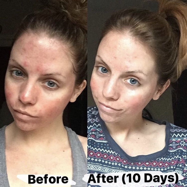 Acne Treatment Dr. Rob Berberian Newport Beach Orange County