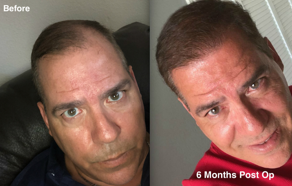 2500-grafts-hair-transplant-surgery-2-dr-rob-berberian-before-and-after-hdw4.jpg