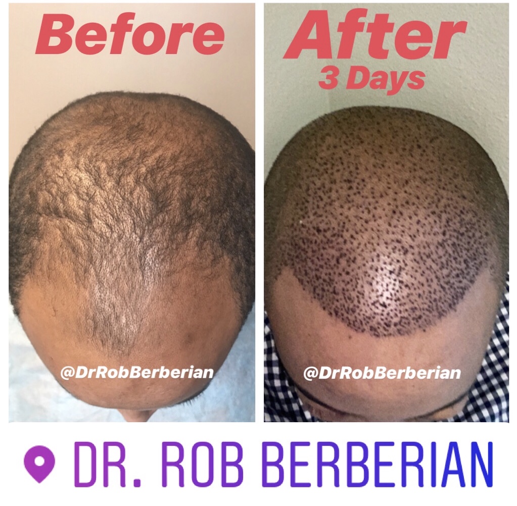 Dr. Rob Berberian FUE Hair Transplant African American Hair