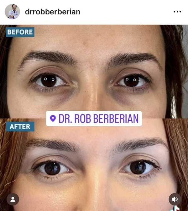 Celebrity Under Eye Treatment Filler PRP - Dr. Rob Berberian - Los Angeles & Newport Beach, CA