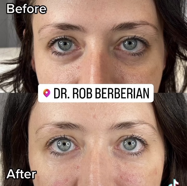 Celebrity Under Eye Treatment Filler PRP - Dr. Rob Berberian - Los Angeles & Newport Beach, CA