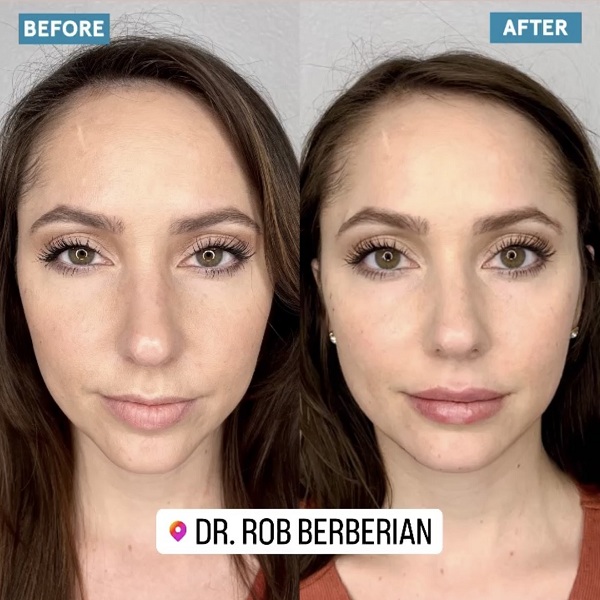 Dr. Rob Berberian - Celebrity Facial Sculpting