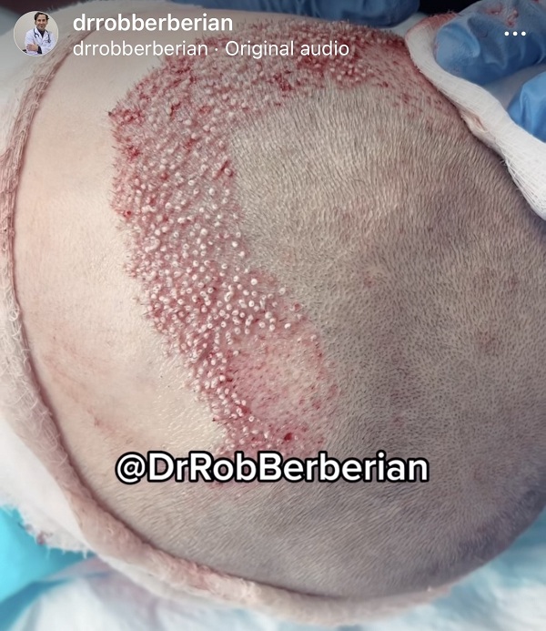 Dr. Rob Berberian - FUE Hair Transplant Los Angeles Newport Beach