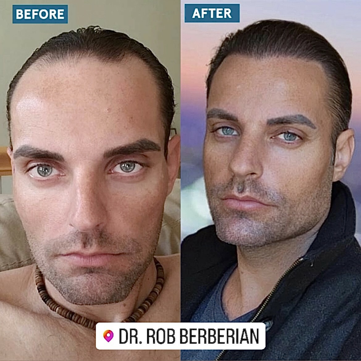 Dr. Rob Berberian FUE Hair Transplant Los Angeles Newport Beach California Before After