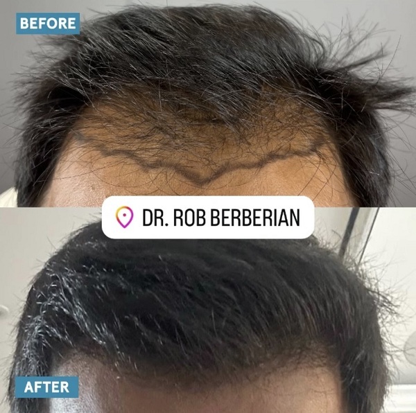 Dr. Rob Berberian FUE Hair Transplant Los Angeles Newport Beach California Before After