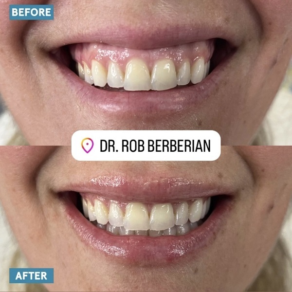 Dr. Rob Berberian Gummy Smile Treatment Los Angeles & Newport Beach