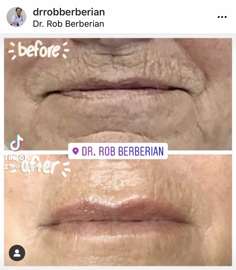 Dr. Rob Berberian - Zero Bruising Lip Filler Newport Beach