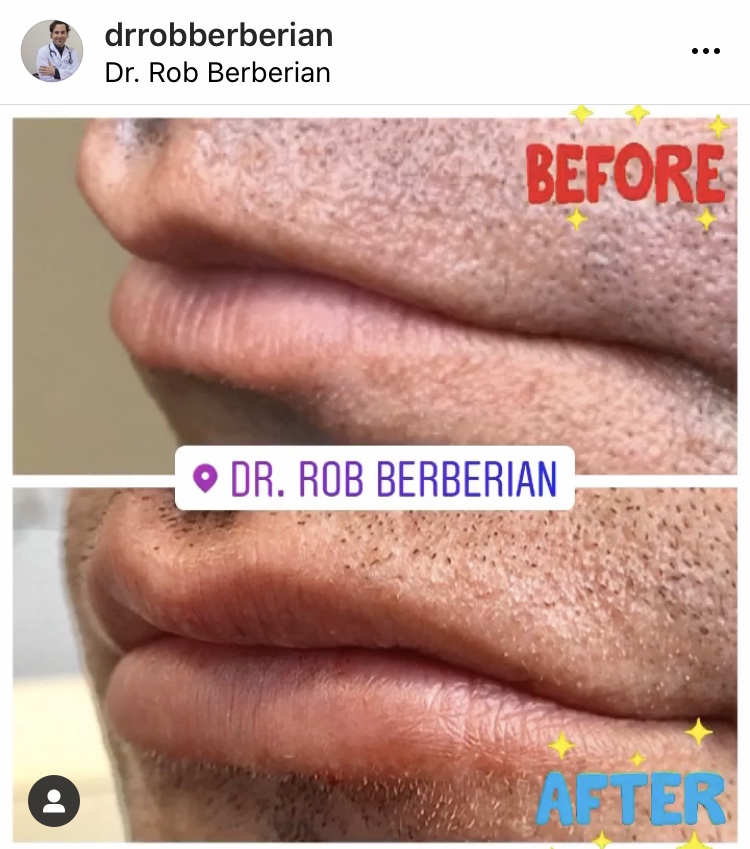 Dr. Rob Berberian - Zero Bruising Lip Filler Newport Beach