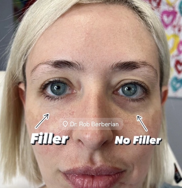 Celebrity Under Eye Treatment Filler PRP - Dr. Rob Berberian - Los Angeles & Newport Beach, CA