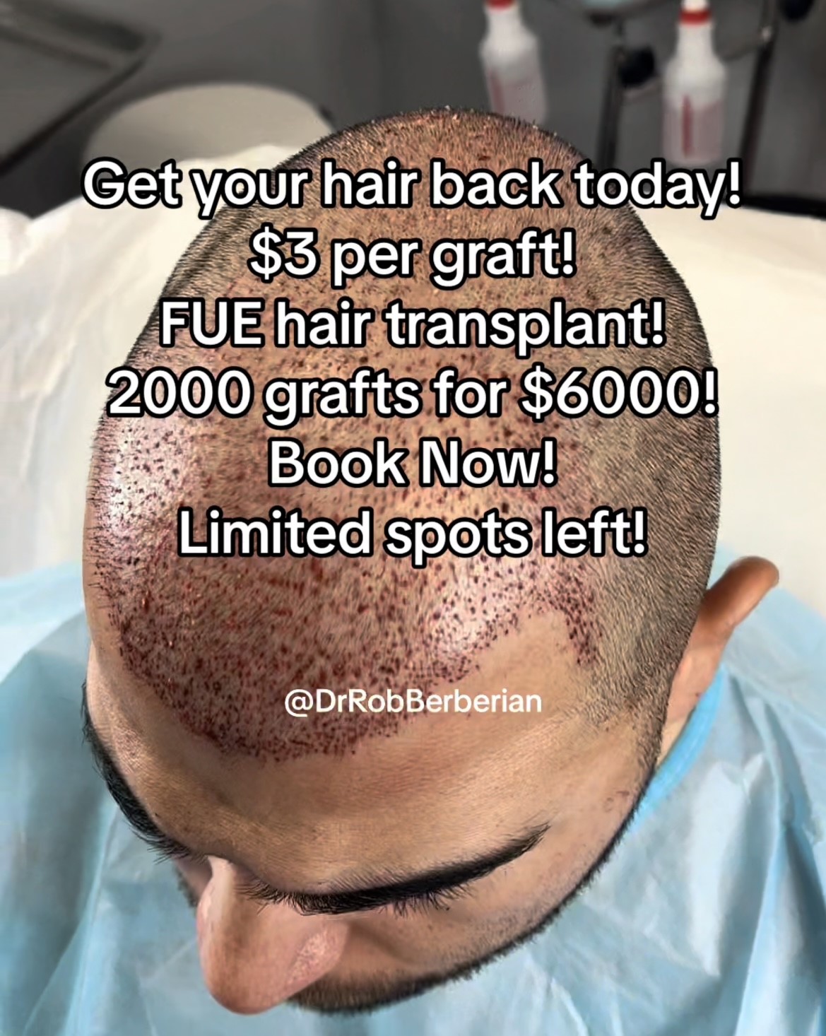 FUE Hair Transplant 3 per Graft USA