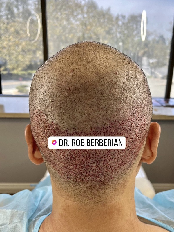 trypophobia-fade-dr.-rob-berberian-2s-fue-hair-transplant-los-angeles-newport-beach.jpg