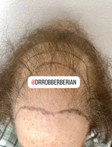 hair loss on glp 1 reddit For those who had SEVERE loss, did it come back after stopping? : r/GLPGrad I have a bald spot