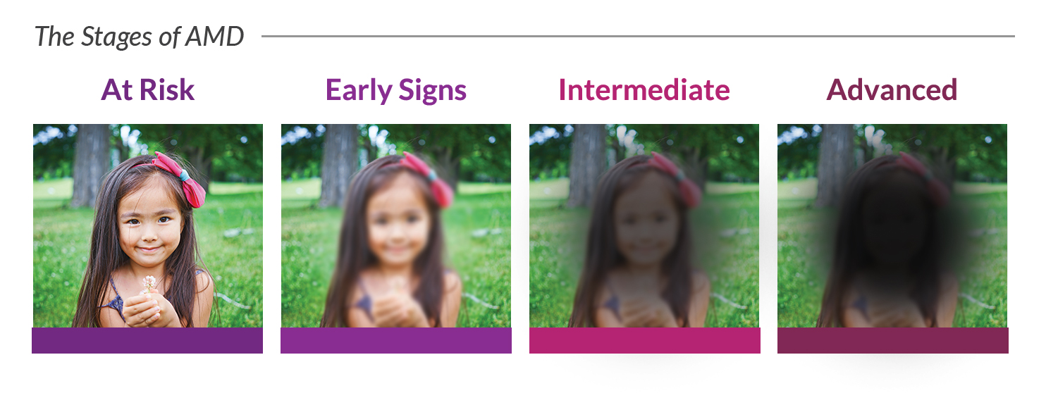 Progression stages of age related macular degeneration. 