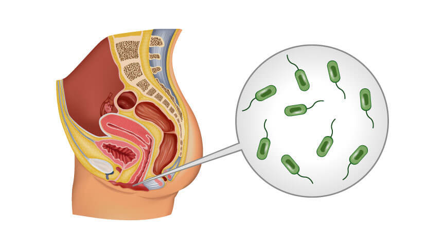 Understanding Bacterial Vaginosis
