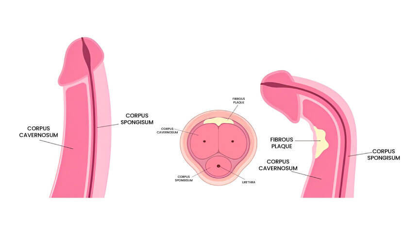 Peyronie's Disease