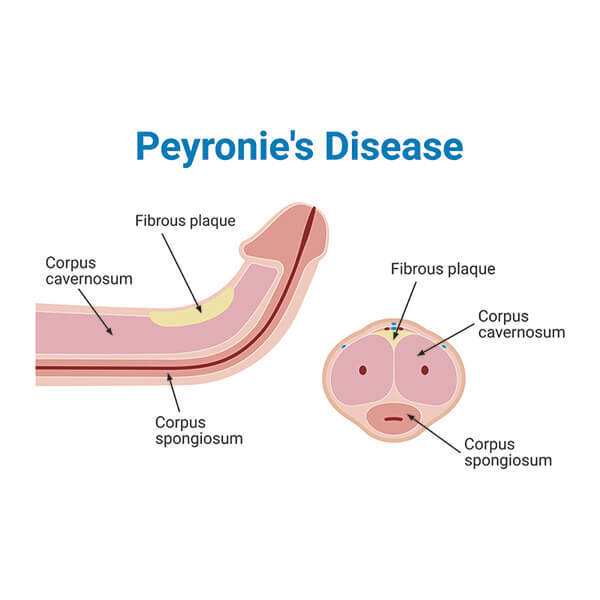 Understanding Peyronie’s Disease (Penile Curvature and Pain)