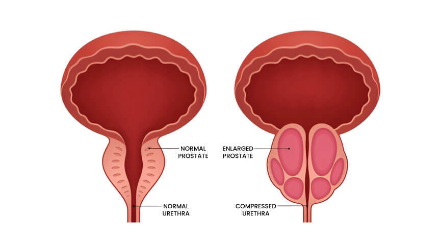 Prostate Surgery–Related ED