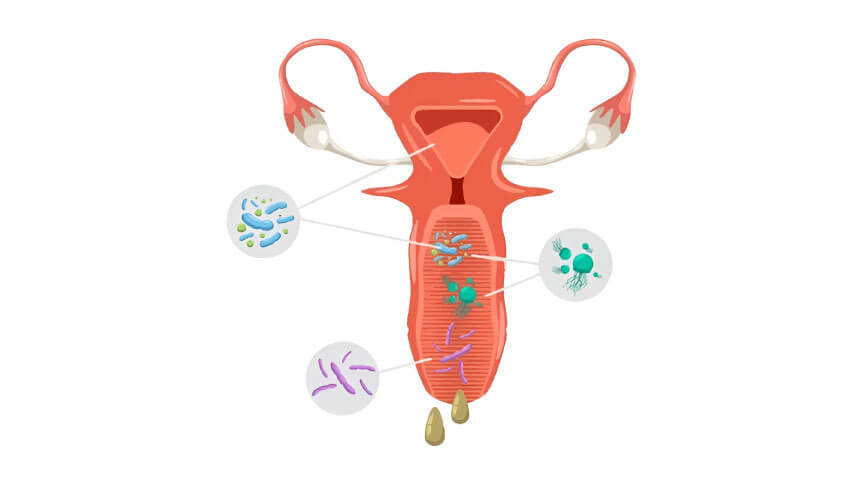 Understanding Bacterial Vaginosis