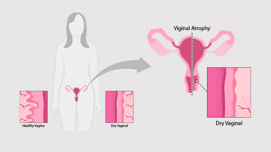 Vaginal Dryness: Causes, Symptoms & Effective Relief