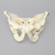 Pelvis with Disruption and Wall Fractures, Full Male, Solid Foam Pelvis with Disruption and Wall Fractures, Full Male, Solid Foam