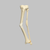 Tibia and Fibula with Malunions, Varus, and Procurvatum Tibia and Fibula with Malunions, Varus, and Procurvatum