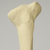 Tibia with Proximal and Distal Deformity Tibia with Proximal and Distal Deformity