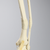 Foot and Ankle with Distal Malunion and Rotation Foot and Ankle with Distal Malunion and Rotation
