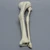 Tibia and Fibula with Malunions and Plane Defect Tibia and Fibula with Malunions and Plane Defect