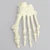 Forefoot with Hammertoes, Bunions, and Exostosis, Left Forefoot with Hammertoes, Bunions, and Exostosis, Left