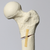 Femur with Subtrochanteric Oblique Fracture Femur with Subtrochanteric Oblique Fracture
