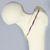 Femur with Intertrochanteric Fracture and Small Fragment Femur with Intertrochanteric Fracture and Small Fragment