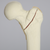 Femur with Intertrochanteric Fracture with Fragment
