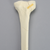 Tibia with Condylar, Oblique, and Spiral Fractures Tibia with Condylar, Oblique, and Spiral Fractures