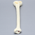 Tibia with "Y" Fracture Tibia with "Y" Fracture